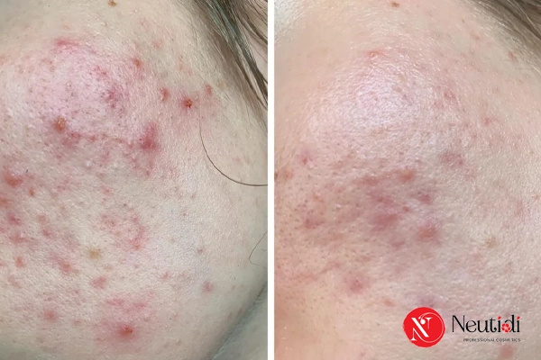 Những lưu ý khi điều trị thâm mụn