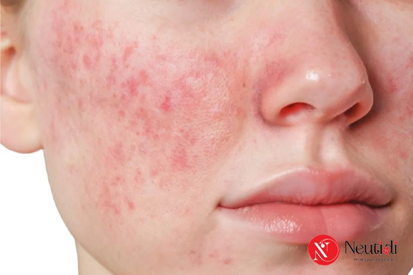 Không dưỡng ẩm và chống nắng đúng cách cho da mụn