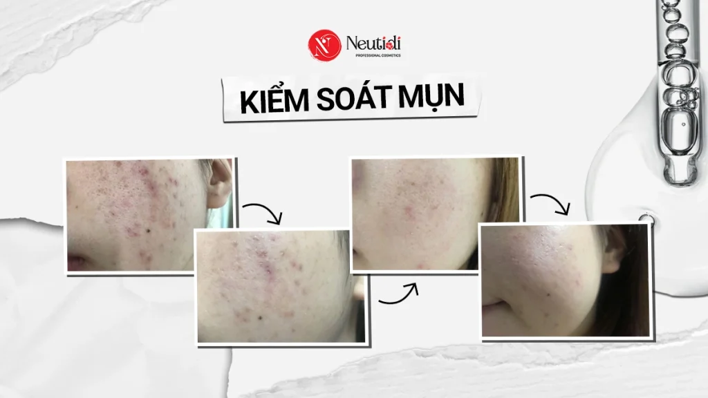 Kiểm soát mun là gì?