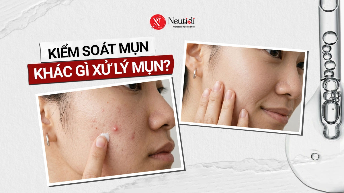 Kiểm soát mụn khác gì xử lý mụn?