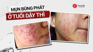 Mụn bùng phát ở tuổi dậy thì