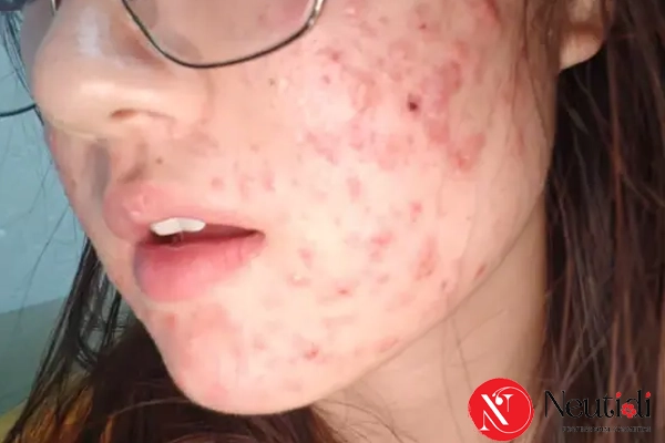 Mụn bùng phát ở tuổi dậy thì