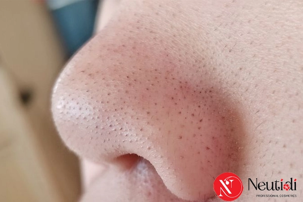 Phân biệt 10 loại mụn trên mặt theo chuẩn y khoa 2 Mụn đầu đen