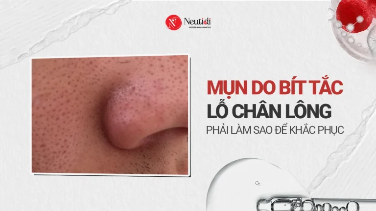 Mụn do bít tắc lỗ chân lông