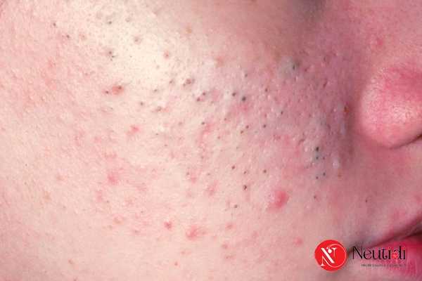 Mụn do bít tắc lỗ chân lông là gì