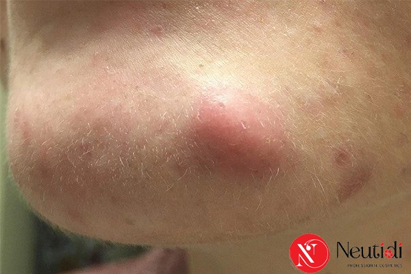 Phân biệt 10 loại mụn trên mặt theo chuẩn y khoa 5 Mụn nang