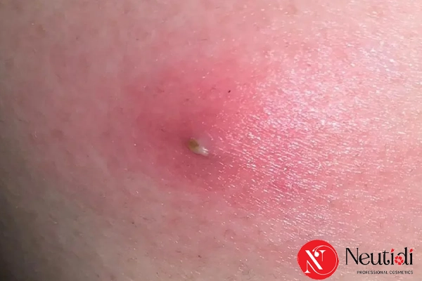 Phân biệt 10 loại mụn trên mặt theo chuẩn y khoa 4 Mụn nhọt