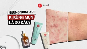 Tại sao ngưng skincare thì bị bùng mụn