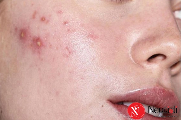 nguyen nhan da dau de noi mun 1