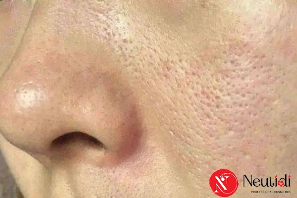 Nguyên nhân da dầu lỗ chân lông to