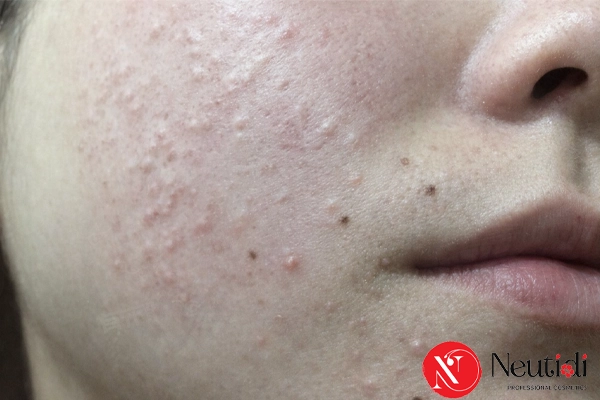 Nguyên nhân bị nổi mụn khi ngưng sử dụng mỹ phẩm