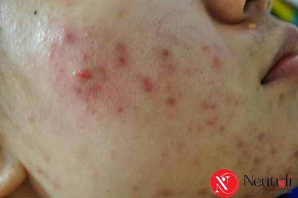 Bùng mụn do ngưng dùng corticoid bao lâu thì hết