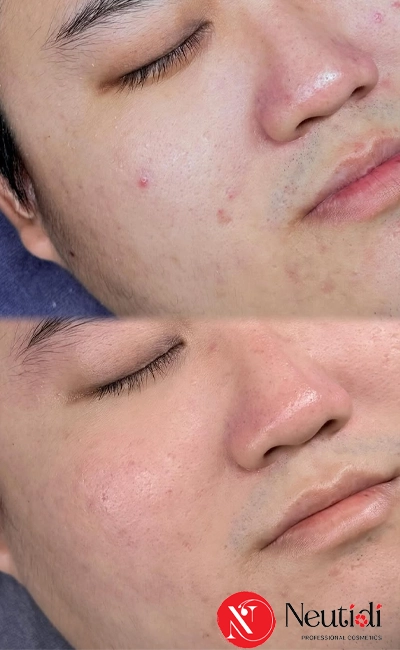 Quy trình chăm sóc da dầu mụn lỗ chân lông to