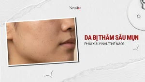 Thâm sau mụn là gì? Phân biệt thâm đỏ, thâm đen & Cách trị hiệu quả 23 Da bị thâm mụn