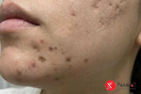 Thâm sau mụn là gì, trông như thế nào?