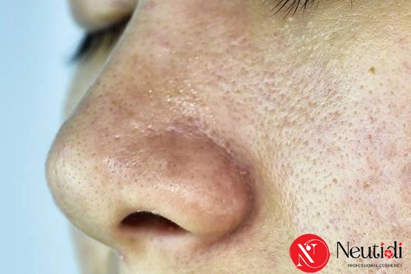 Thói quen khiến da thêm dầu mụn lỗ chân lông to