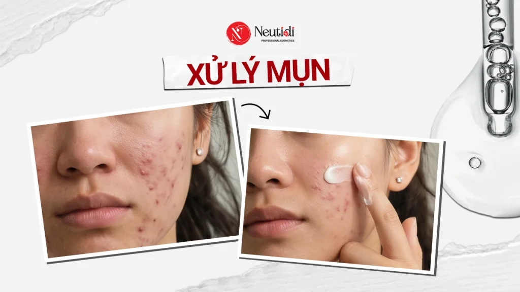 Thế nào là xử lý mụn