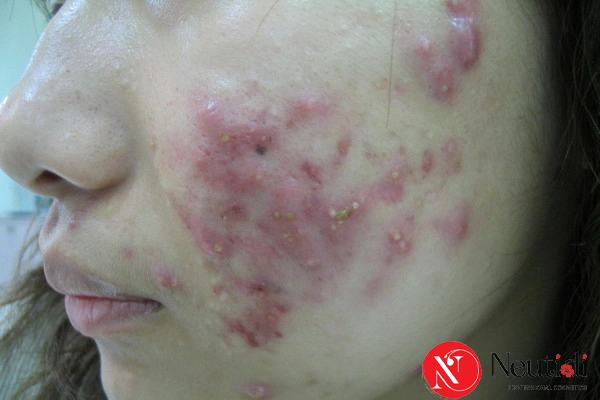 Xử lý mụn nặng bùng phát tuổi dậy thì
