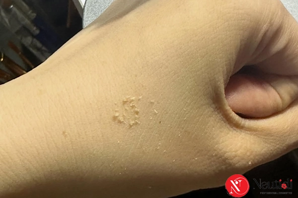 BHA với các cách trị sợi bã nhờn khác