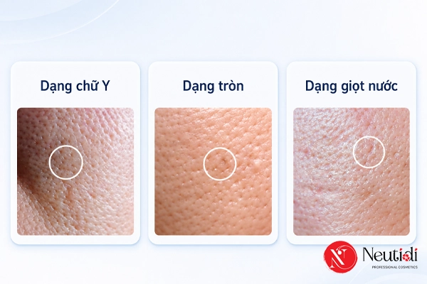 3 dạng lỗ chân lông to phổ biến