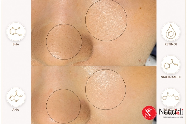 Các hoạt chất trị mụn ẩn hiệu quả