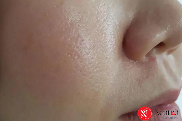 Da Dầu Nhờn Là Gì? Hiểu Đúng Để Không Chăm Sai 2 Cách nhận biết da dầu
