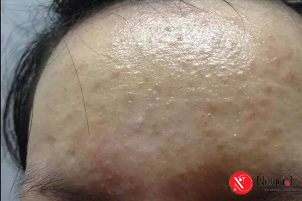 Trị da dầu vĩnh viễn được không? Nên xử lý đúng như thế nào? 2 Da dầu có trị vĩnh viễn được không?