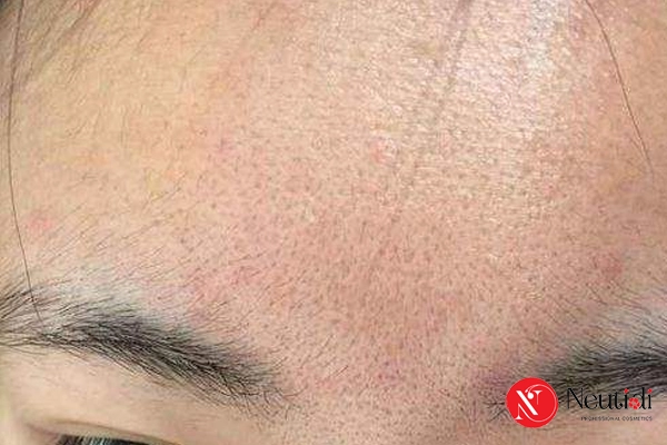 Dấu hiệu da mặt bị bít tắc lỗ chân lông & 5 bước xử lý hiệu quả 2 Dấu hiệu da bị bít tắc lỗ chân lông