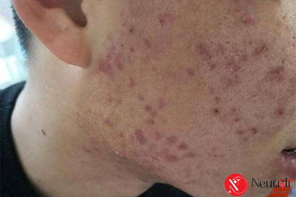 Hậu quả mụn trứng cá có thể làm ảnh hưởng tâm lý người mắc
