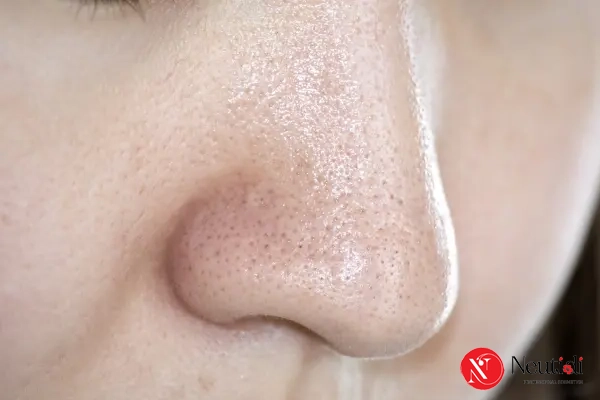 Hậu quả của da dầu vùng chữ T