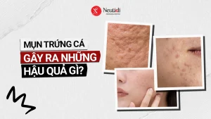 Những hậu quả của mụn trứng cá