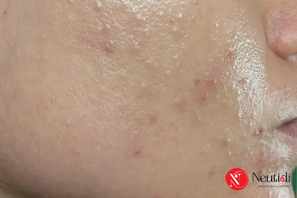 Xử lý lỗ chân lông to cho da nhờn hiệu quả tại nhà 3 Xử lý và kiểm soát dầu nhờn là bước đầu giúp thu gọn lỗ chân lông to
