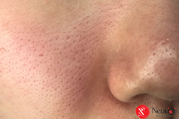 Lỗ chân lông to do bị giãn nở vĩnh viễn