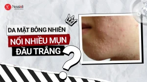 Da mặt bỗng nhiên nổi nhiều mụn đầu trắng