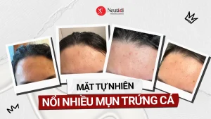 Mặt tự nhiên nổi mụn trứng cá là do đâu?