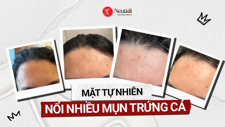 Mặt tự nhiên nổi mụn trứng cá là do đâu?