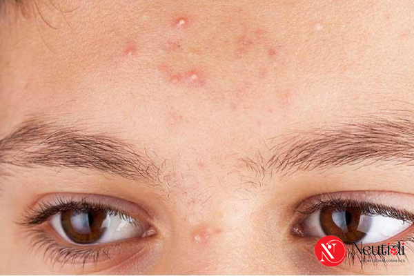 Mụn đầu trắng: Nguyên nhân, nhận biết & cách trị hiệu quả 3 Làm sao để nhận biết đúng mụn đầu trắng?