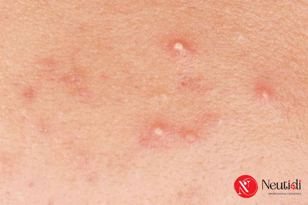 Mụn đầu trắng: Nguyên nhân, nhận biết & cách trị hiệu quả 1 Mụn đầu trắng trông như thế nào?