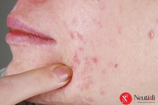 Phát ban mụn do dùng corticoid trông như thế nào