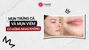 Mụn trứng cá và mụn viêm