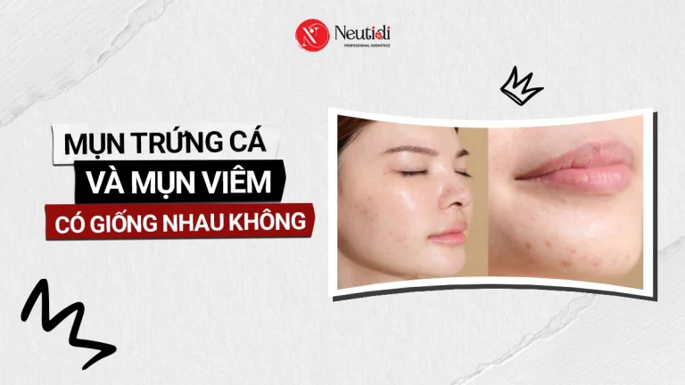 Mụn trứng cá và mụn viêm