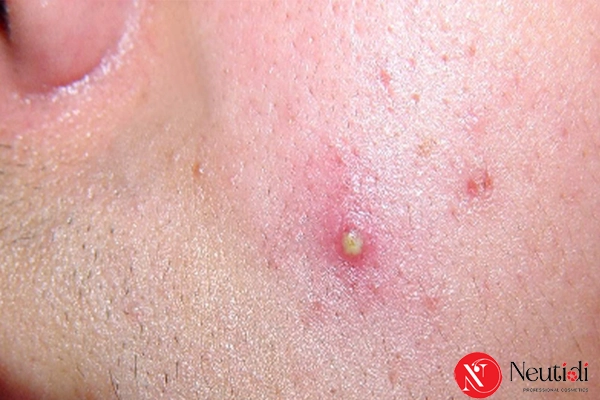 Mụn viêm là gì