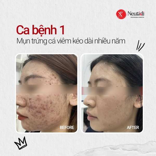 Ca bệnh 1 - Mụn trứng cá viêm kéo dài nhiều năm