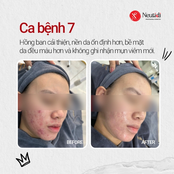Ca bệnh 7