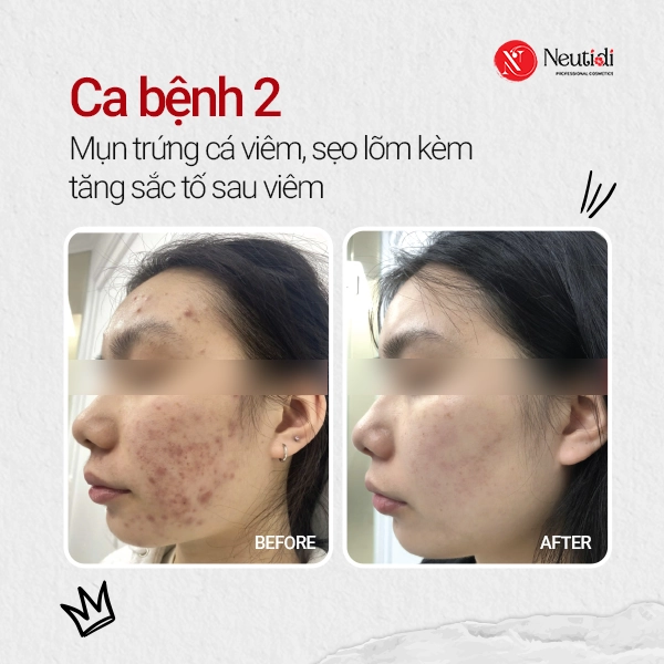 Ca bệnh 2 - Mụn viêm, sẹo lõm, tăng sắc tố sau viêm