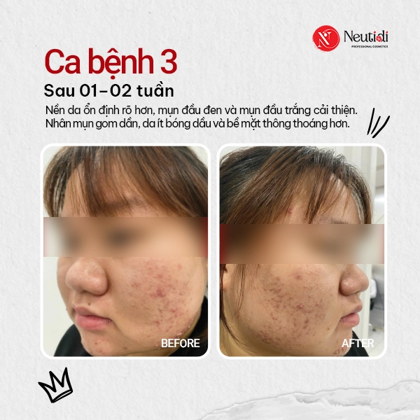 Sau 1-2 tuần, da dần ổn định và mụn bắt đầu có xu hướng gỉam