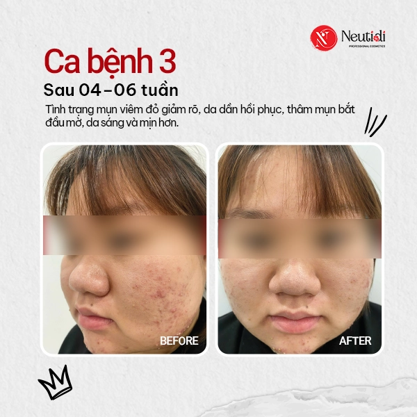 Sau 4-6 tuần, mụn viêm giảm rõ, da dần hồi phục sau thâm mụn