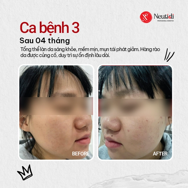 Ca bệnh 3 - Da dầu nhờn, mụn trứng cá kết hợp thâm mụn