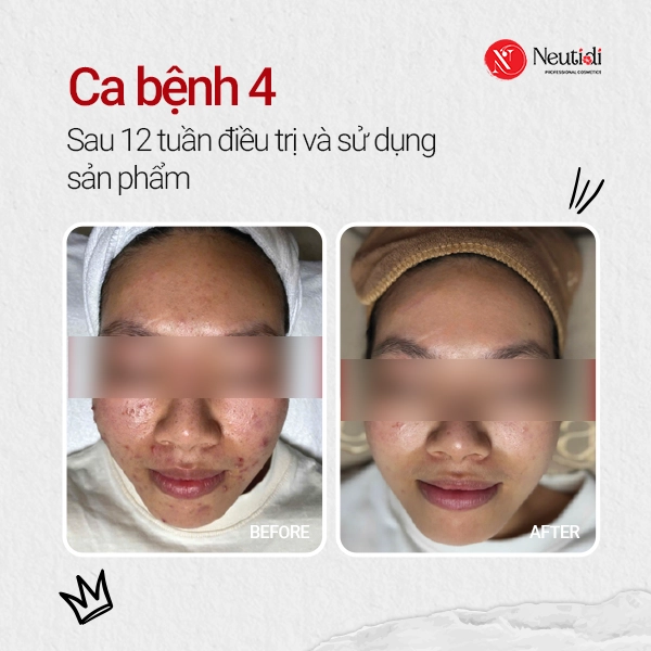 Ca bệnh 4