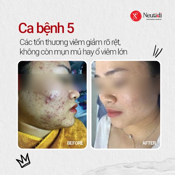 Ca bệnh 5